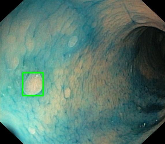 Endoscopy image with square-highlighted lesion